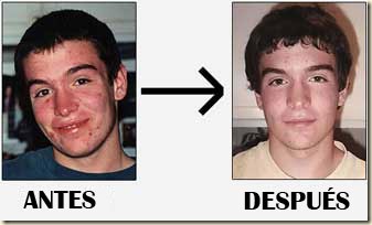El peeling de la persona de los puntos negros antes y después
